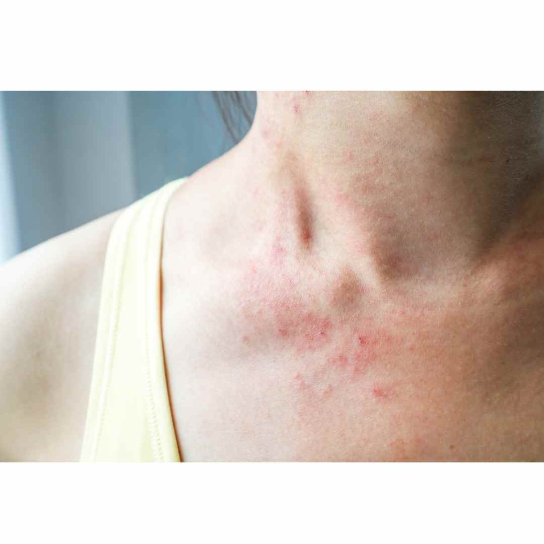 woman with a skin rash
